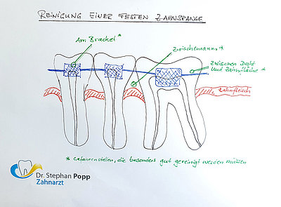 Feste Zahnspange reinigen