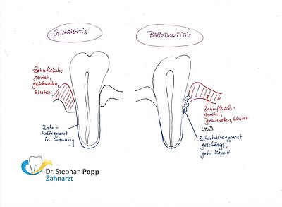 Gingivitis Zahnfleischentzündung Behandlung