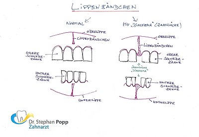 Lippenbändchen Diastema OP entfernen durchtrennen