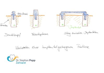 implantatgetragene Prothese