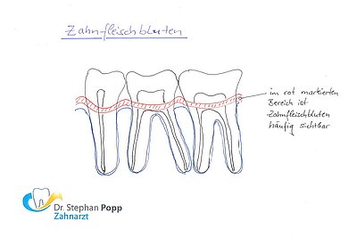 Zahnfleischbluten Ursachen stoppen