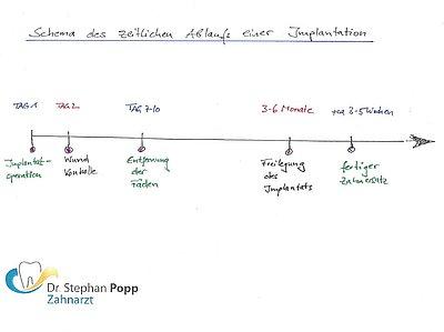 zeitlicher Ablauf Zahnimplantat