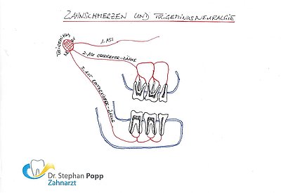 Zahnschmerzen Trigeminusneuralgie