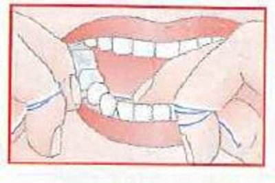Zahnseide richtig benutzen