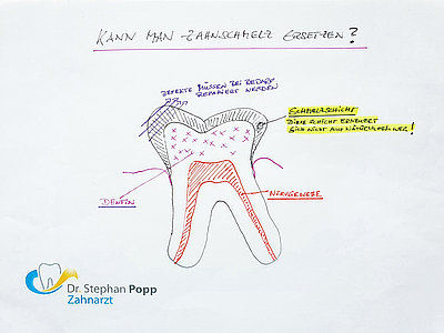 Kann man Zahnschmelz ersetzen