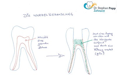 Wurzelbehandlung