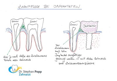 Zahnimplantat Pflege