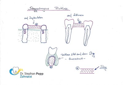 Implantatgetragene Stegprothese auf Implantaten auf Zähnen