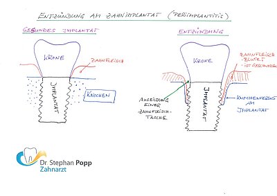 Entzündung Zahnimplantat Periimplantitis 