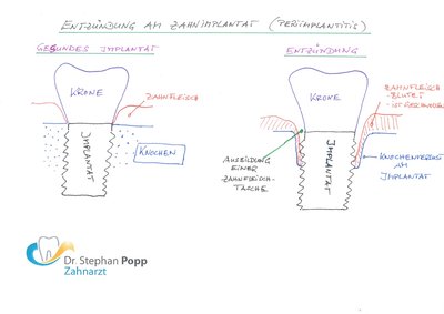 Entzündung Zahnimplantat Periimplantitis 
