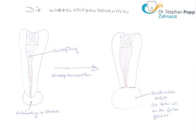 Wurzelspitzenresektion WSR