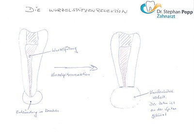 Wurzelspitzenresektion WSR