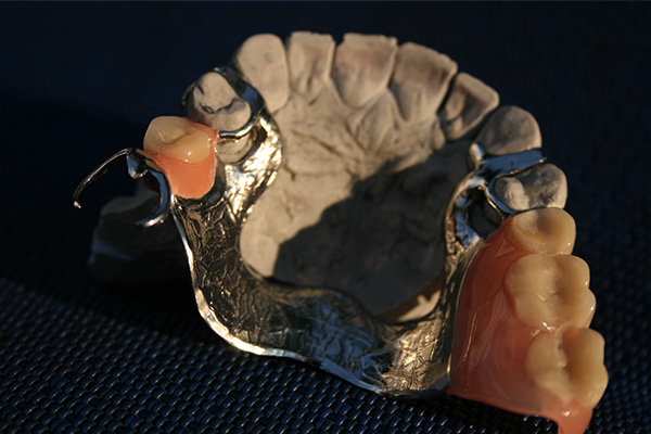 Klammerprothese